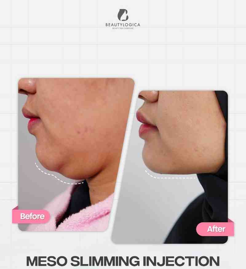 Perawatan Setelah Mesolipo