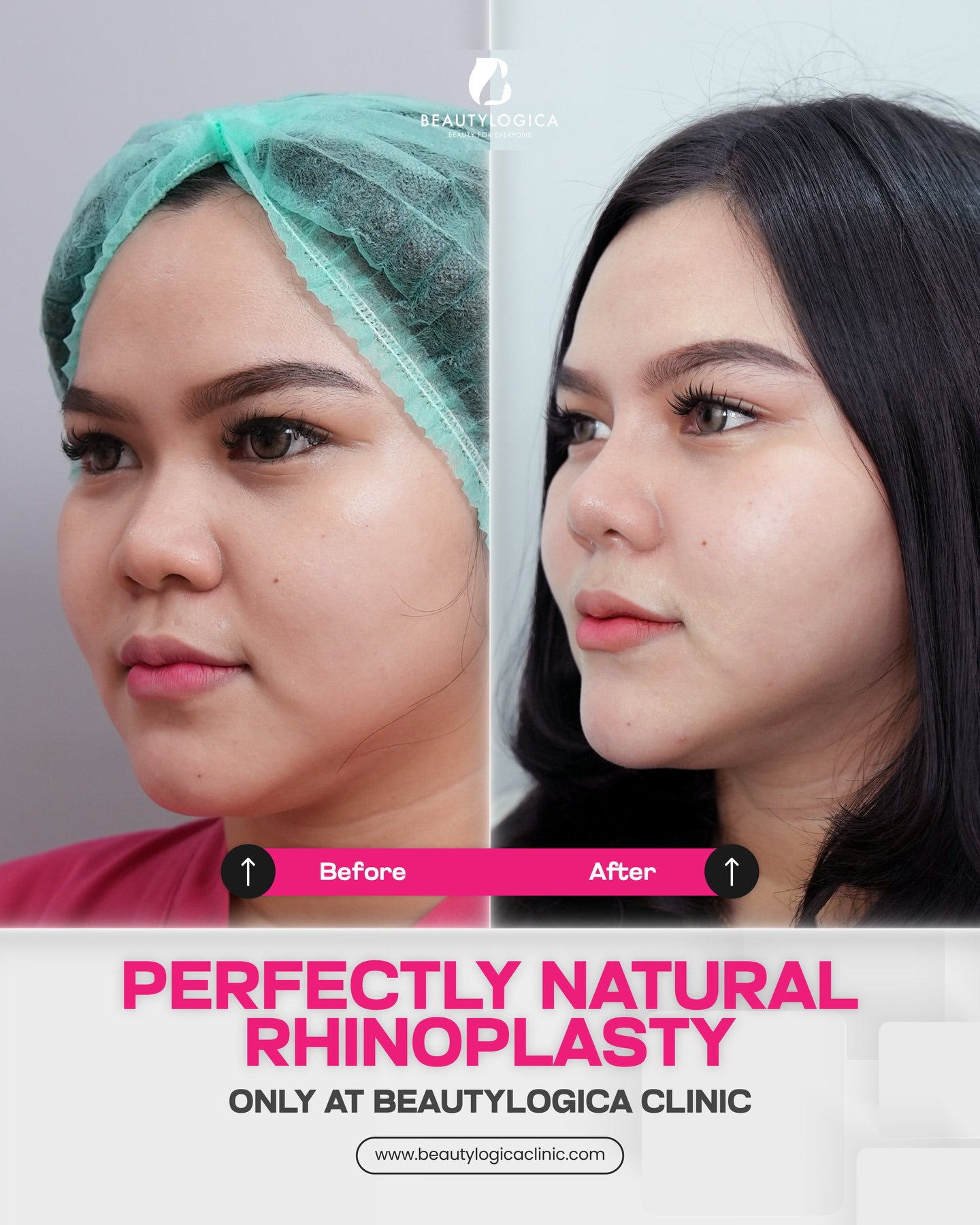 Hal yang Perlu Ditanyakan ke Dokter Sebelum Rhinoplasty di Jakarta Barat