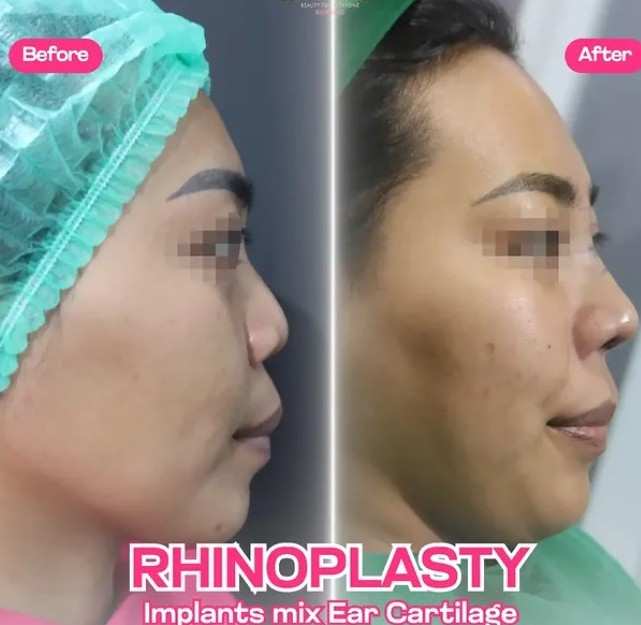 Biaya Operasi Hidung di Bandung Terbaru