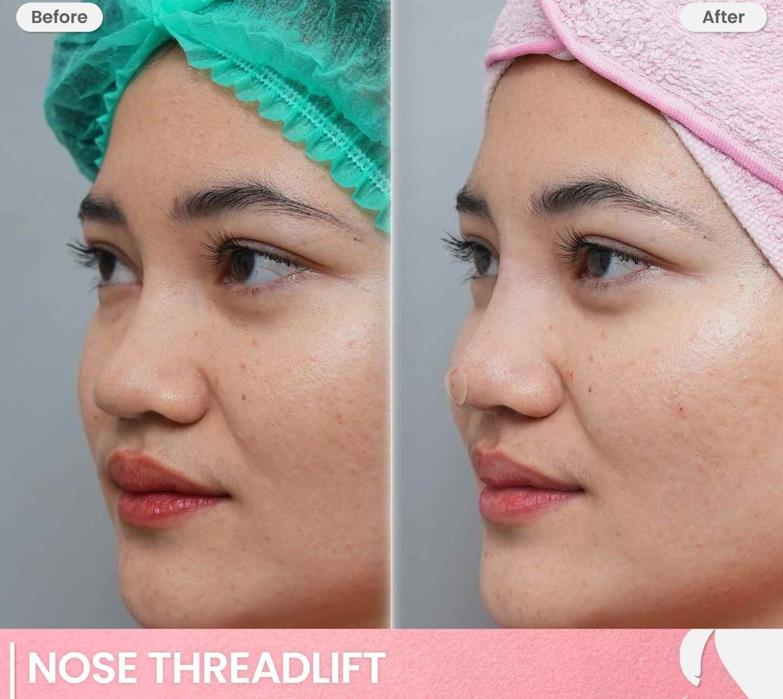 Nose Threadlift Bekasi