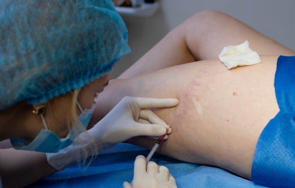 Eksisi Keloid oleh Dokter Bedah Plastik