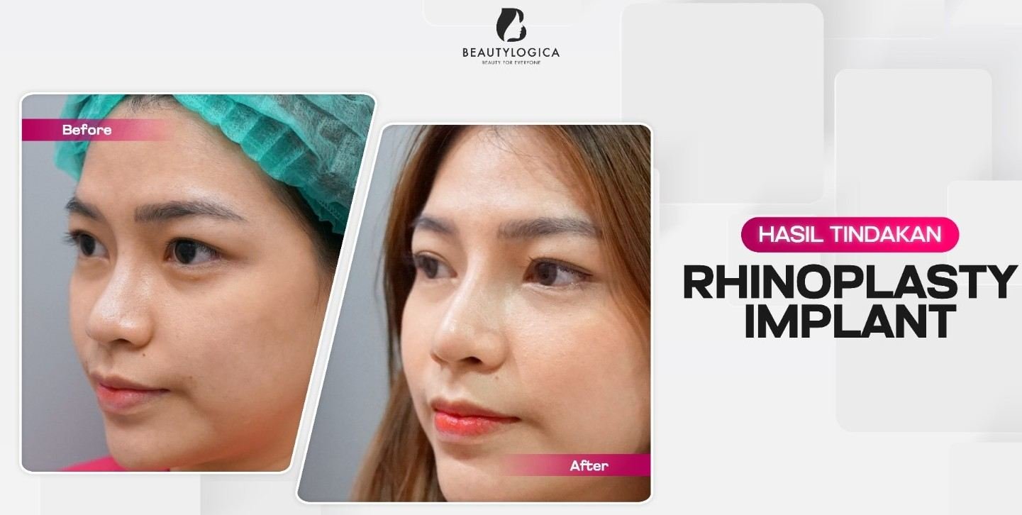 operasi hidung rhinoplasty di Bekasi