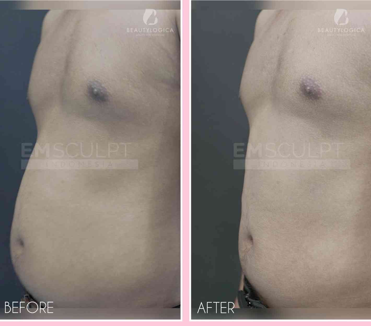 tempat emsculpt terpercaya Jakarta recommended