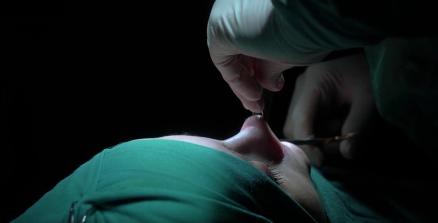 Operasi Cuping Hidung Lebar di Balikpapan