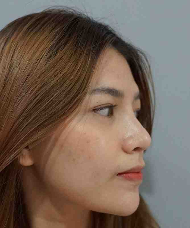 Rhinoplasty Operasi Memancungkan Hidung di Jakarta