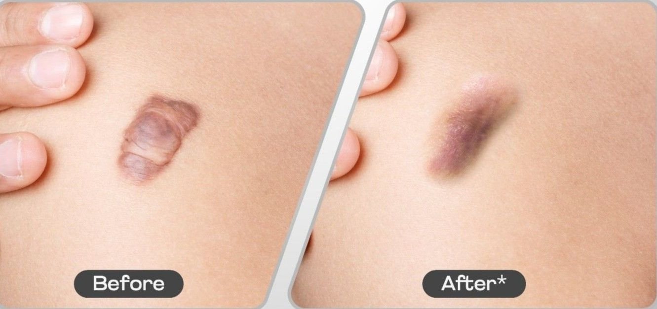 Suntik Keloid atau Eksisi Keloid