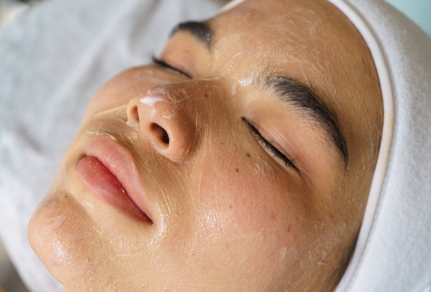 Treatment Pori Besar di Bekasi