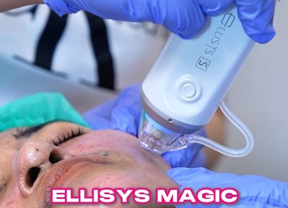 treatment ellisys rf microneedling