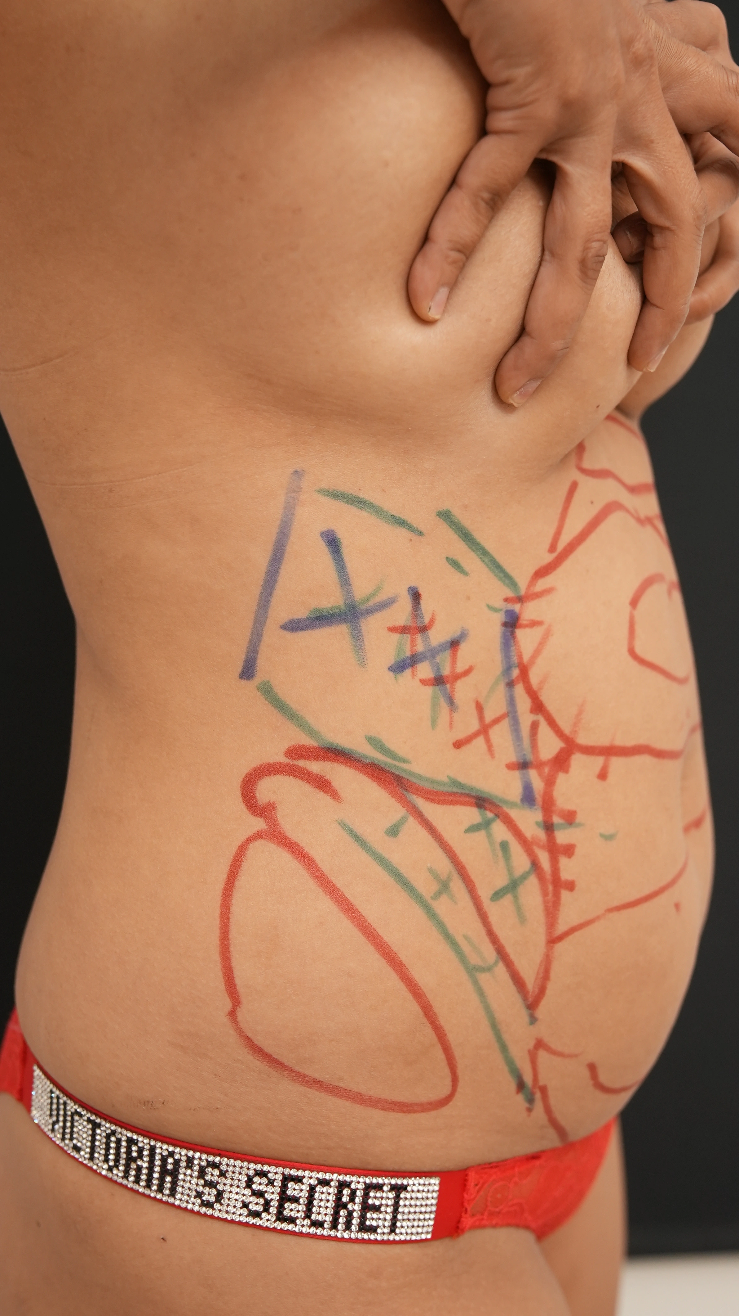 Sedot Lemak Berapa Harganya