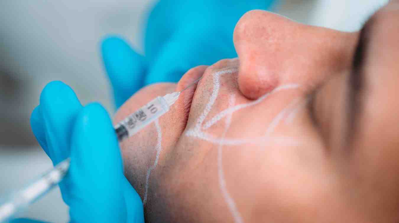 Dermal Filler Wajah Pipi