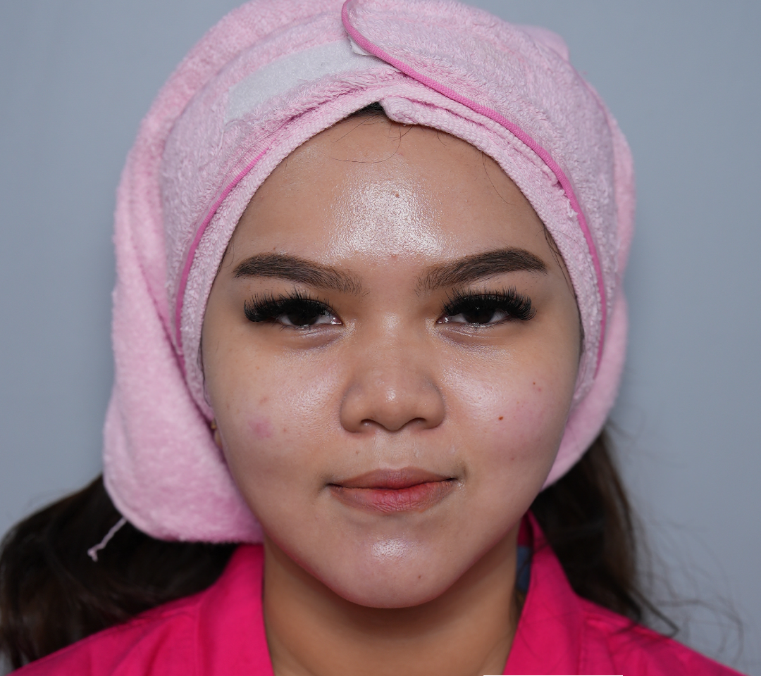 Suntik Botox untuk Wajah Tirus: