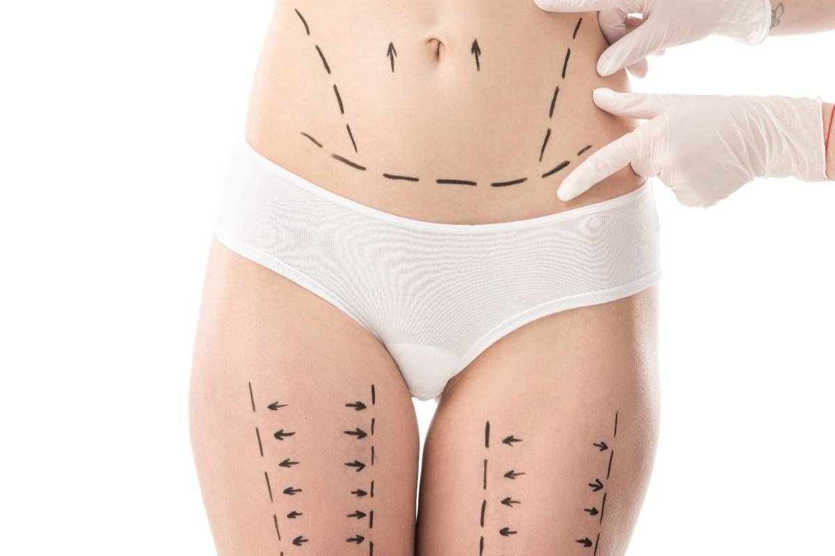 Sedot Lemak atau Tummy Tuck di Balikpapan