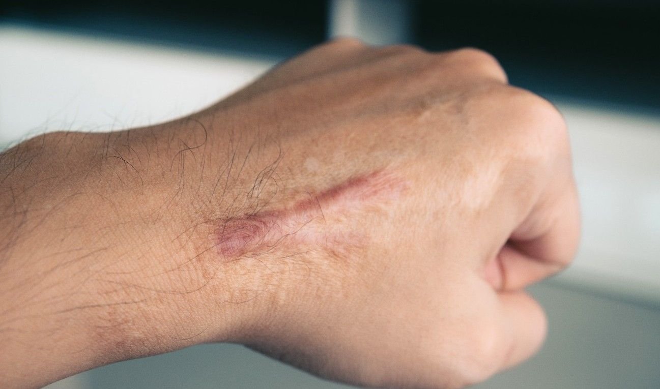 Keloid Kambuh Setelah Operasi