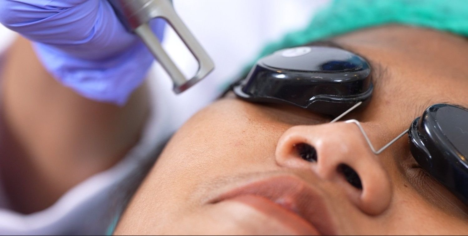 Treatment Melasma di Balikpapan