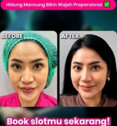 Rhinoplasty Operasi Memancungkan Hidung Beautylogica Clinic