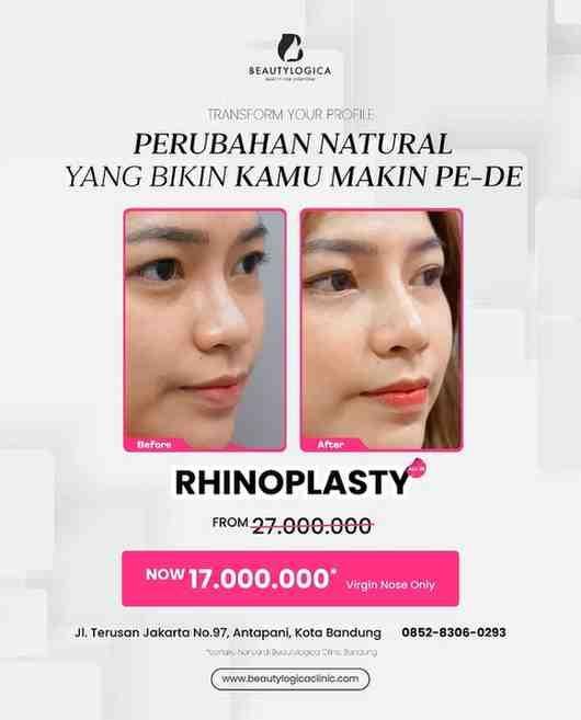 Klinik Operasi Memancungkan Hidung Bandung Rhinoplasty