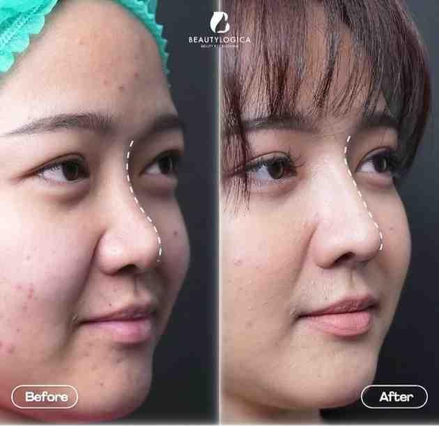 Rhinoplasty Operasi Memancungkan Hidung di Jakarta