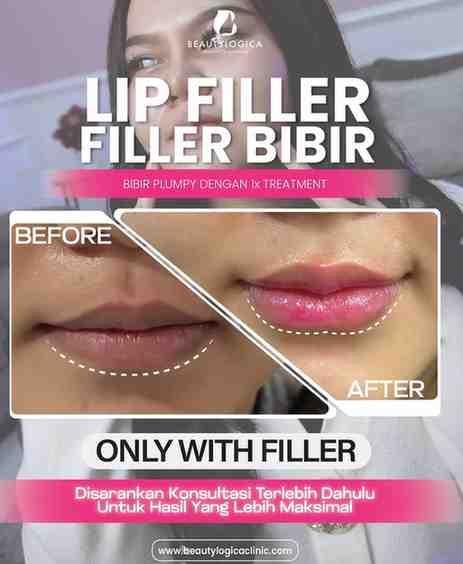 Filler Bibir
