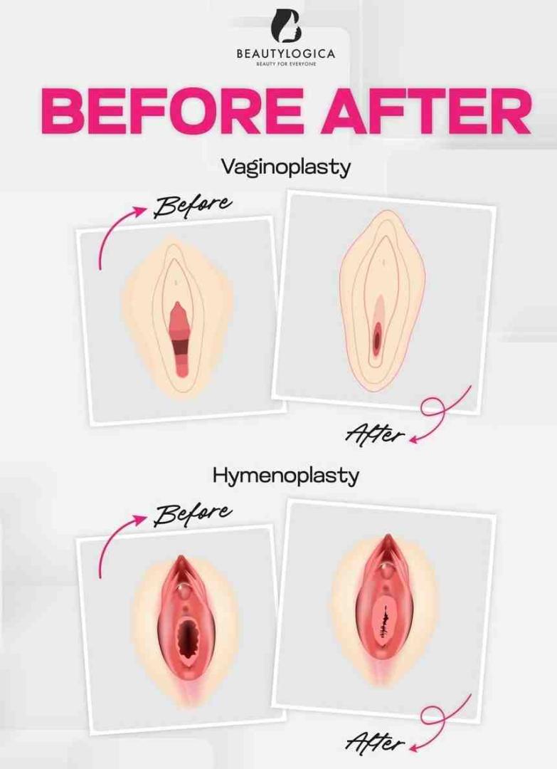 Operasi Selaput Dara Bandung: hymenoplasty bandung operasi keperawanan